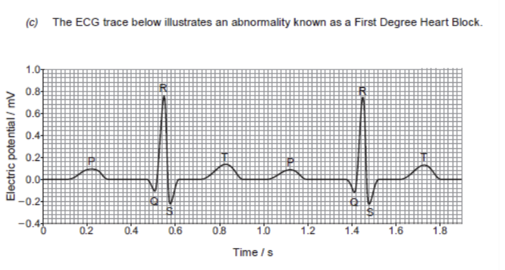 <p>(ii) Conclude which region of the conducting tissue of the heart is affected by first degree heart block. </p>