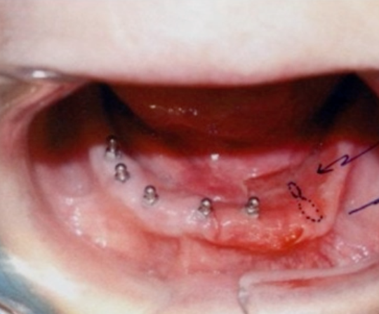 <p>60 y/o male with pain in lower anterior ridge, what is the CLINICAL diagnosis</p>