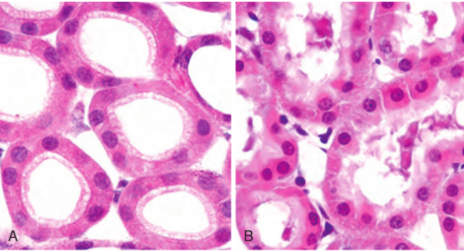 <p>Daño células irreversible presenta alteraciones citológicas características, incluyendo cambios en tinción citoplasmática, cuál es la causa principal de este fenómeno:</p>