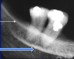 <p>Radiopaque line below external oblique ridge</p>