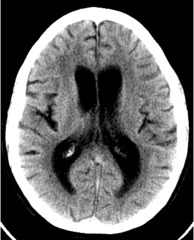 <p>abnormal accumulation of fluid (CSF) in the brain</p><p>Aqueductal stenosis (AS) is a the most common cause of congenital obstructive hydrocephalus</p>