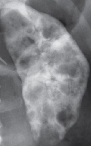 <p>Hereditary disorder marked by multiple cysts of varying size scattered throughout one or both kidneys</p><ul><li><p>“Bunch of grapes” scattered throughout the kidney</p></li></ul><p></p>