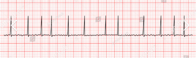 <p>Identify the following rhythm?</p>