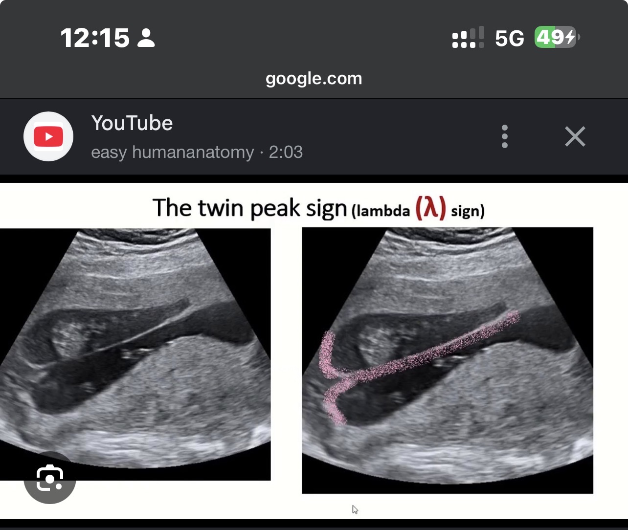<p>Dichorionic gestation</p>