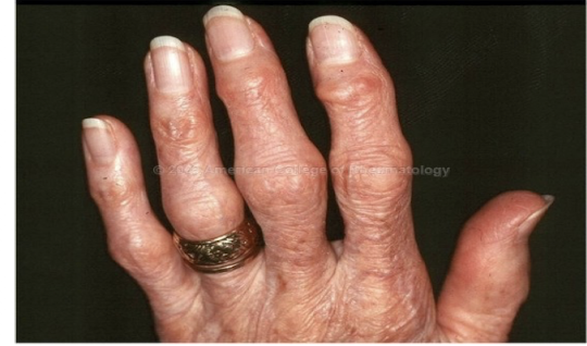 <p> proximal joint </p>