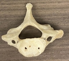 <p>prominent to spinous process and can be palpated</p>
