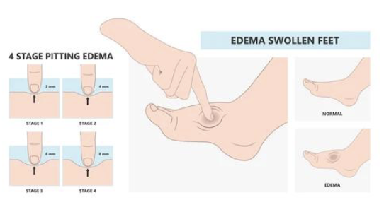 <p>temporary swelling caused by water retention</p><ul><li><p>often heart or venous issues (associated w/ systemic problems: heart failure, hepatic cirrhosis)</p></li><li><p>leaves dimple when pressed</p></li><li><p>usually responds to elevation + meds (diuretics)</p></li></ul><p></p>
