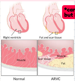 <p>A heart condition that causes <strong>abnormal</strong> changes in the heart <strong>muscle</strong>, especially the right ventricle, leading to <strong>irregular</strong> heart rhythms or arrhythmias.</p>