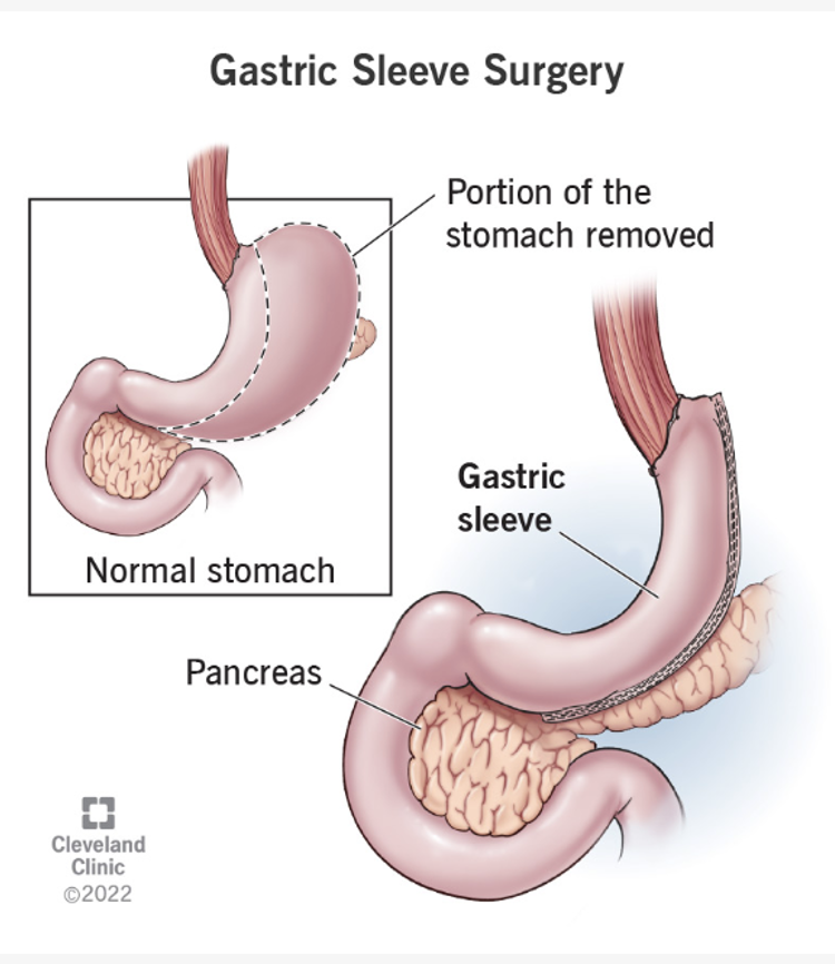 <p>removes a large portion of the stomach, creating a tube-like structure. This limits food intake and results in hormonal changes that help with weight loss. </p>