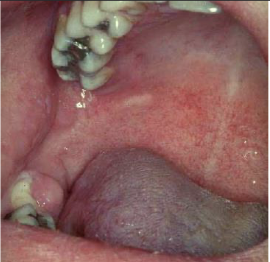 <p>what is this disease</p>
