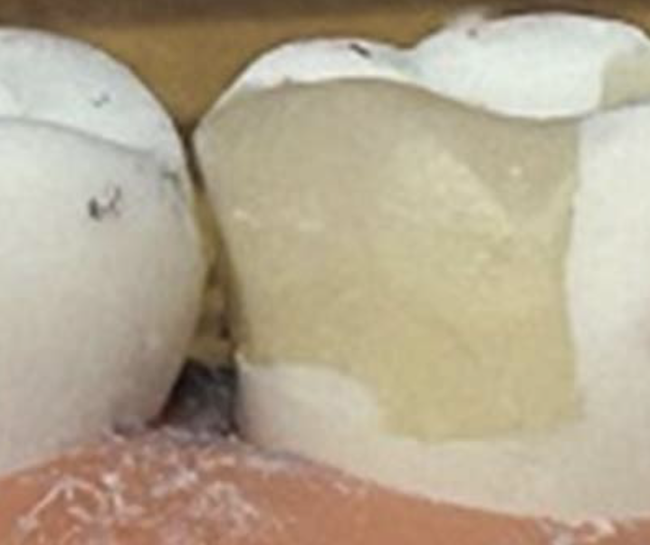 <p>How should you fix this restoration?</p>