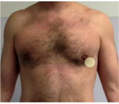 <p>mitral regurgitation</p><p>đź’ˇmitral valve best heard at 5th ICS at midclavicular line (APE To Man) & aortic valve best heard at 2nd ICS just right of the sternum</p><p>-systolic murmur = mitral regurg or aortic stenosis (MR. AS on top) </p><p>-diastolic murmur = mitral stenosis or aortic regurg (MS. AR on bottom)</p>