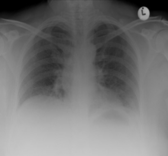 <p>the included image is an example of _______ interferring with the x-ray as the ANTERIOR portion of 5-7 ribs are NOT visable at the midclavicular line</p>