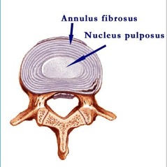 <p>1. Annulus Fibrosus</p><p>2. Nucleus Pulposus</p>