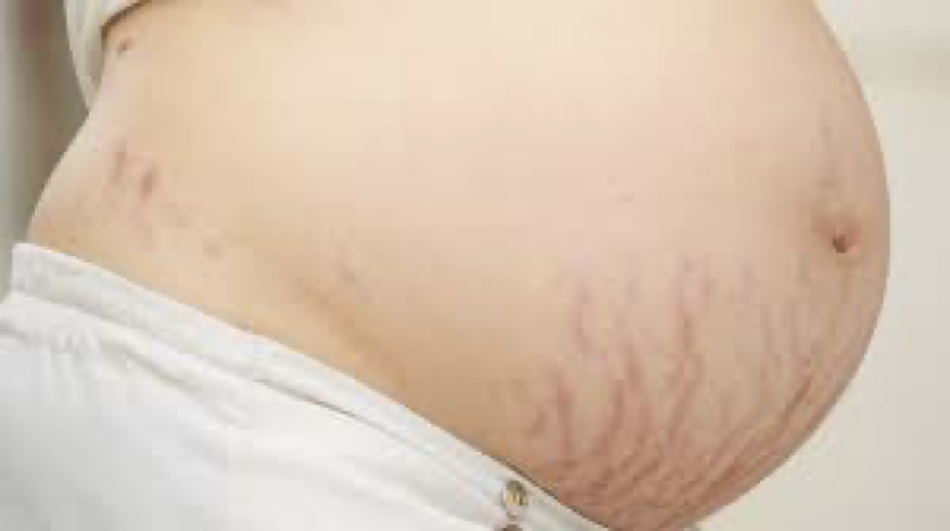 <p><strong>phsiological changes: integumentary system</strong></p><ul><li><p>abdominal skin stretches</p><ul><li><p>expansion of abdomen</p></li><li><p>fat disposition</p></li></ul></li><li><p>stretch marks: ___</p></li><li><p><u>linea negra</u> (formation of line down the stomach<u>)</u>, <u>chloasma</u> (darkening of cheeks, chin, forehead<u>)</u>: due to ___</p></li></ul><p></p>