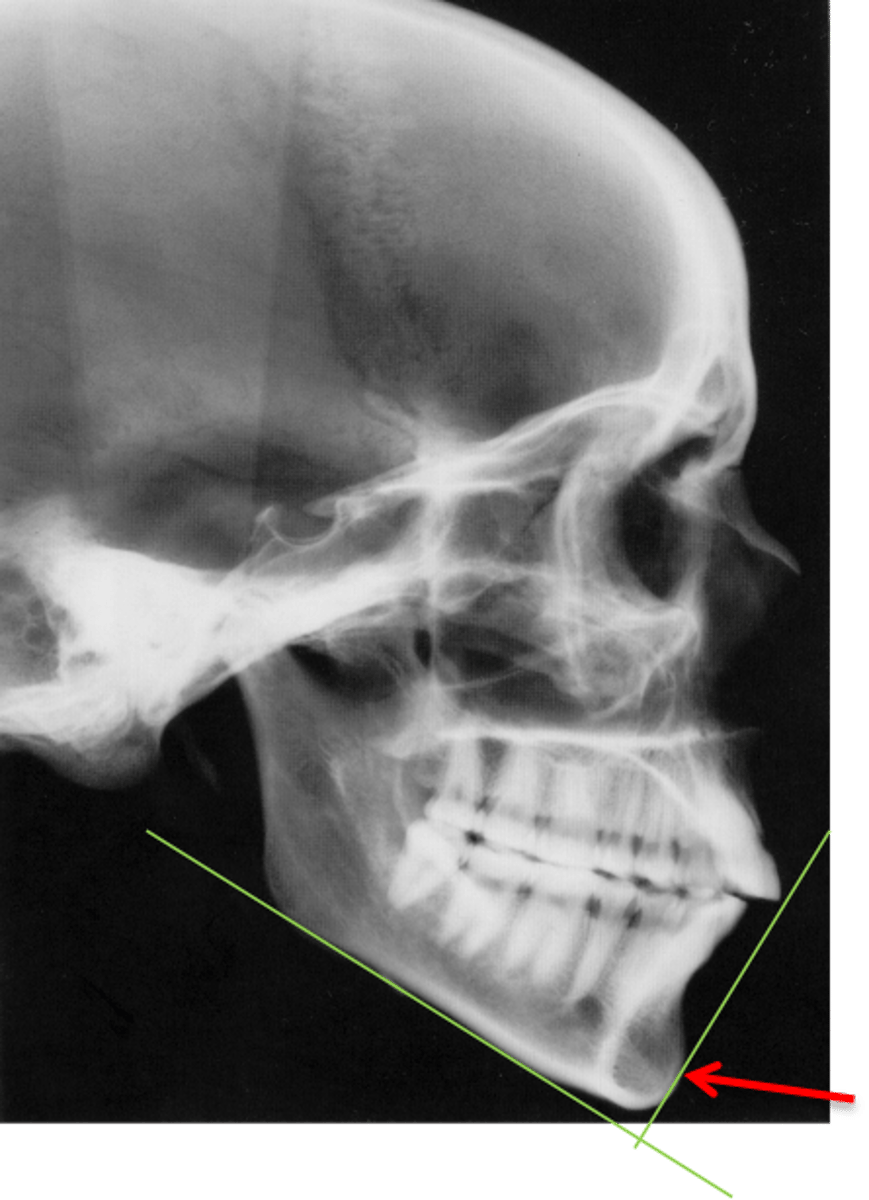 <p>which anatomical landmark:</p><p>- Most anterior point on the mid-sagittal symphysis</p>