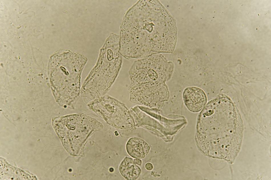 <p>Large, Irregular borders, Distinct nucleus</p><p>Causes: Normal Cellular Sloughing</p>