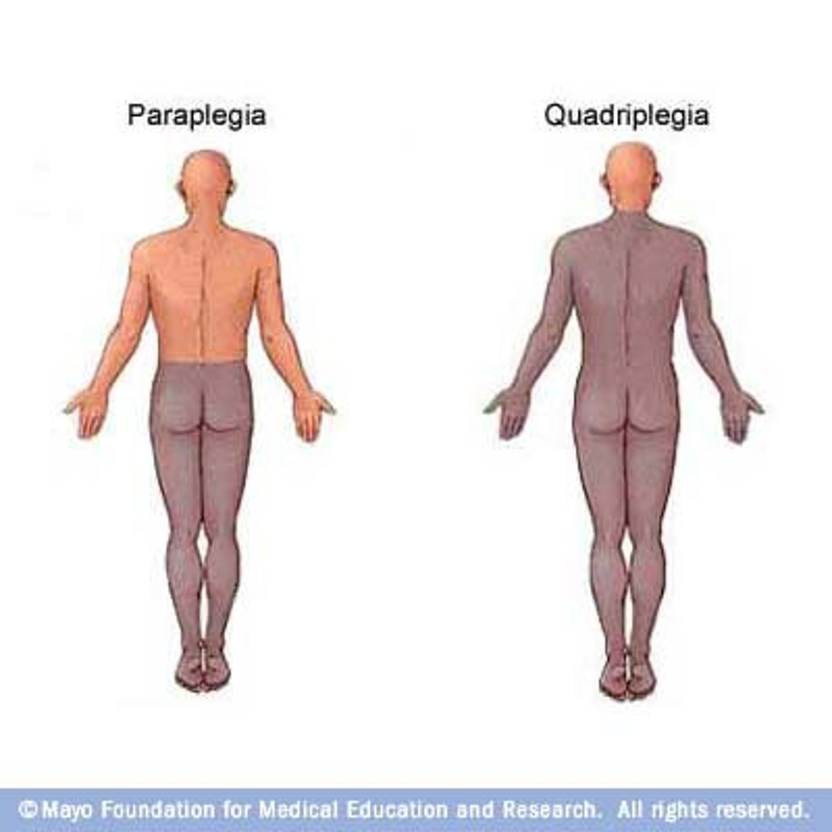 <p>Permanent paralysis affecting all body systems.</p>