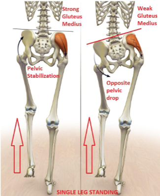 <p>hip abductors, primarily the gluteus medius and gluteus minimus muscles on the supported (stance) side, innervated by the superior gluteal nerve and are critical for maintaining pelvic stability during unilateral weight-bearing activities. The reason the pelvis drops on the unsupported side is due to a failure of the "hip abductor mechanism." To prevent the pelvis from tilting downward toward the unsupported leg under the force of gravity, the gluteus medius and minimus on the weight-bearing side must contract isometrically (contracting without changing length, like holding a plank). This contraction pulls the ilium (origin) toward the greater trochanter of the femur (insertion), effectively "levelling" the pelvis. If these muscles are weak, paralysed, or inhibited by pain, they can not generate sufficient tension to counteract the weight of the swinging limb and trunk, resulting in the characteristic contralateral pelvic drop.</p>