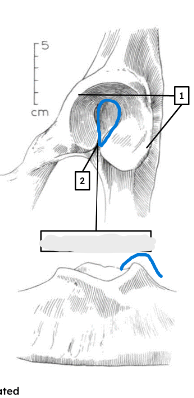 <ul><li><p>narrow acetabular notch</p></li><li><p>rounded lip</p></li></ul><p></p><p>cow pelvis </p><p></p>