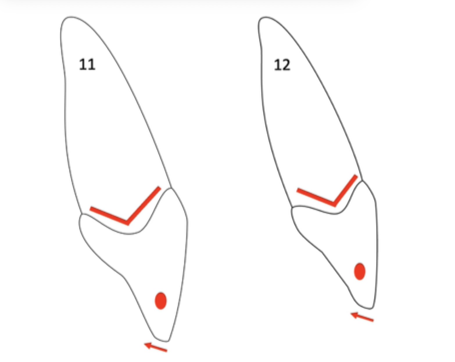 <p>Face distale des incisives centrale et latérale maxillaire droite </p>