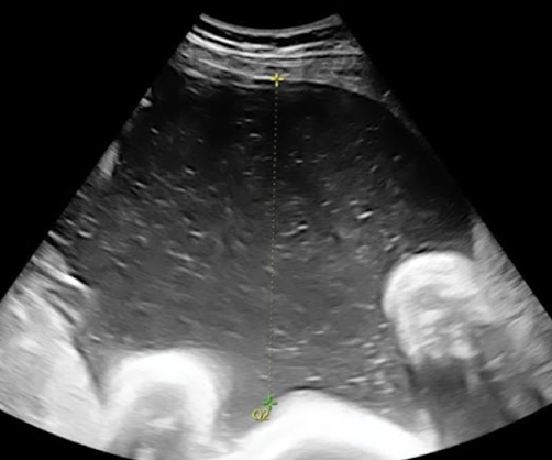 <ul><li><p>2 cm < SP < 8 cm</p><ul><li><p>should be <span style="color: red;">between 2-8 cm</span></p></li></ul></li></ul><p></p>