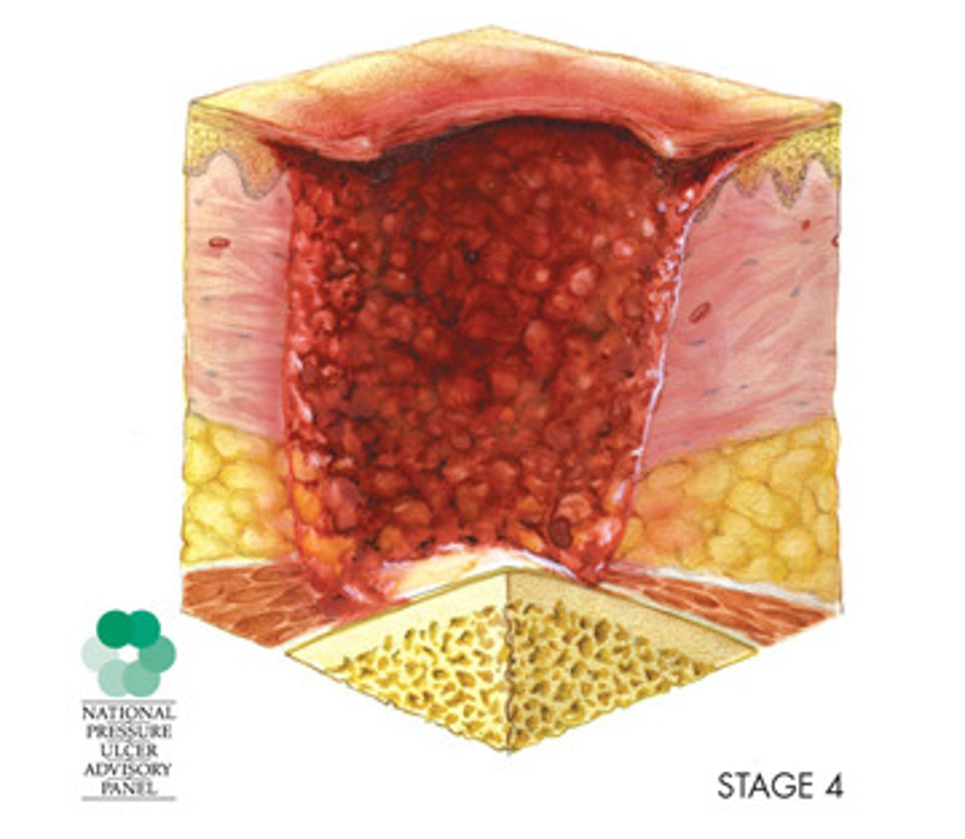 <p>full thickness skin and tissue loss</p><p>-exposed or directly palpable fascia, muscle, tendon, ligament, cartilage, or bone</p><p>-can have tunneling</p>