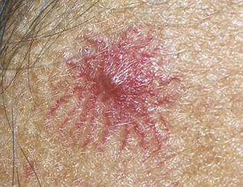 <p>Vascular spider (spider angioma) (vascular lesion)</p>