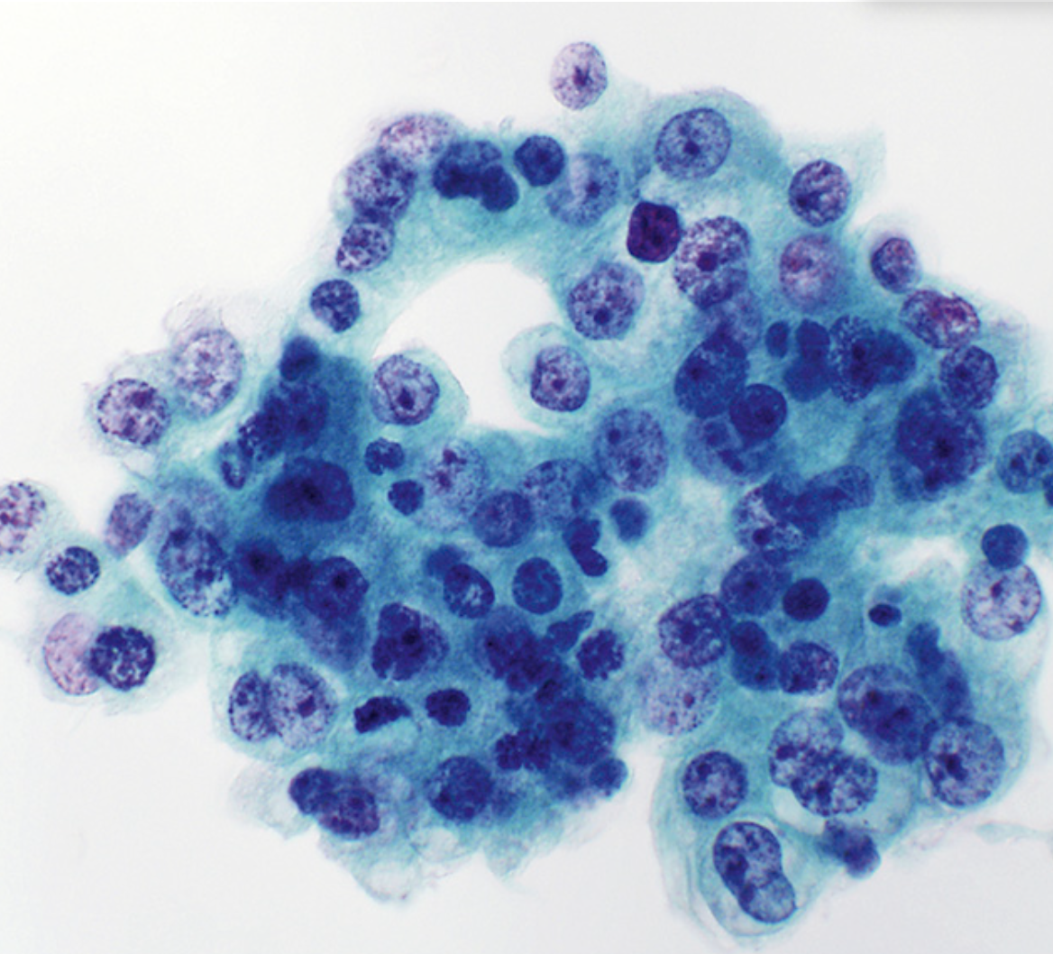 <p>Cytologie salivaire</p><p>1) Catégorie selon Milan</p><p>2) Diagnostic</p>