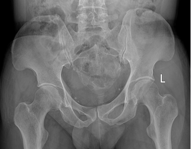 <p>> 40 y.o.; aberrant notochordal cell tumor </p>