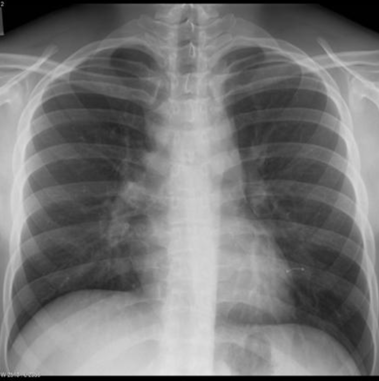 <p>Ivory white vertebrae with anterior body scalloping; uni-lateral hilar lymphadenopathy in caucasian males seen on the PA chest view </p>