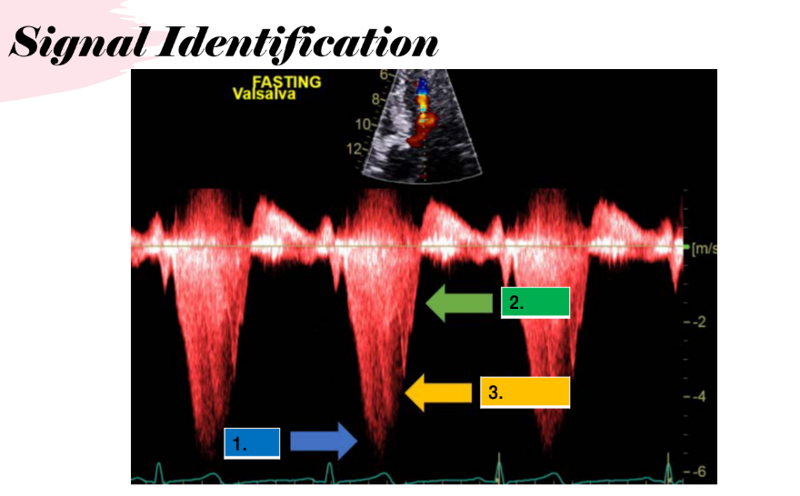 <p>signal identification. and tell me the cardiac cycle </p>