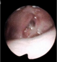 <p>Why is this VPI surgery unsuccessful?</p>