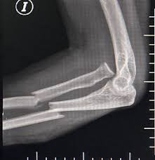 <p>Fractura en esta rx </p>