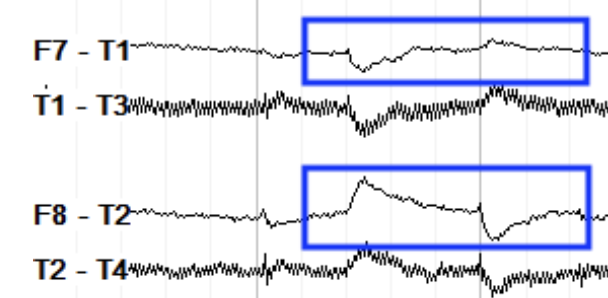 <p>FP2→F8 imagine F8 is more positive so negative or up deflection. then F8 is more than T4 so down deflection. </p>