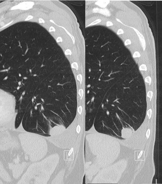 <p>Focal atelectasis with round morphology almost always associated with an adjacent pleural abnormality (effusion, thickening, plaque).<br>Most common in posterior lower lobes.</p>