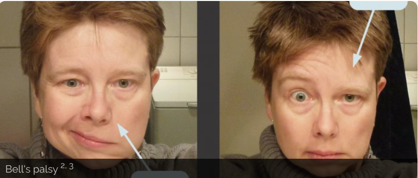 <ul><li><p>Changes in sense of taste (responsible for anterior 2/3 of tongue conveyance of taste)</p></li><li><p>Changes in hearing (paralysis of the stapedius muscle can result in hyperacusis)</p></li><li><p>Asymmetry in the face at rest, particularly the forehead wrinkles, nasolabial folds and angles of the mouth.</p></li><li><p>Impaired ability to raise eyebrow(s) close the eye(s), blow out cheeks against resistance, smile or purse lips.</p></li></ul><p></p>