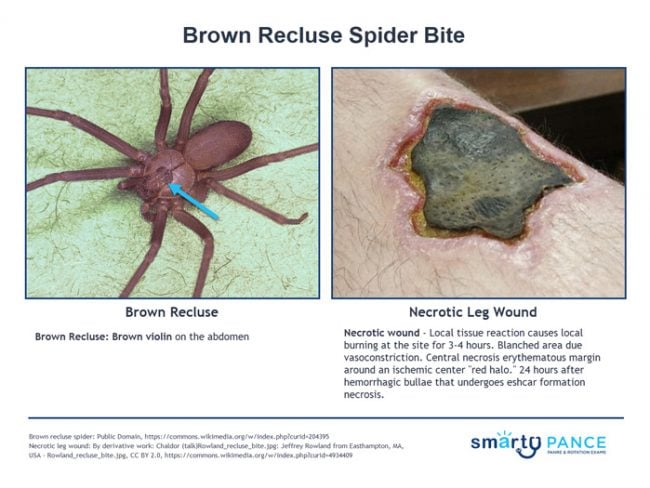 <p>Spider bite with sphingomyelinase D venom</p><p>-Presentation: initial painless bite, then a slowly expanding necrotic ulcer</p><p>-Tx: wound care, rest, ice, compression, elevation </p>