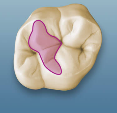 <p>ridge crossing obliquely the occlusal</p><p>surfaces of maxillary molars (from DB cusp to  ML cusp)</p>