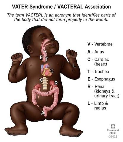 <p><strong><mark data-color="yellow" style="background-color: yellow; color: inherit;">tracheoesophageal fistula</mark></strong></p><p>associated with VACTERL</p>