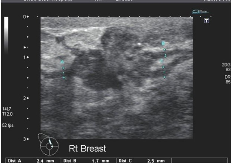 <p>What is the pathology on this breast US</p>