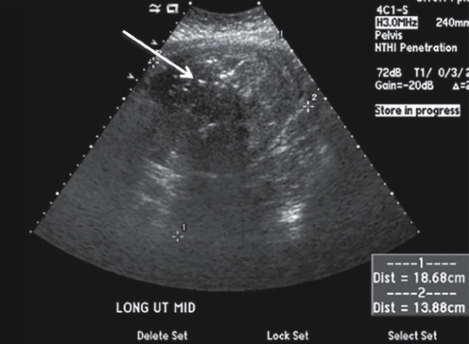 <p>Thickened echogenic or irregular endometrium</p><p>Endometrial fluid</p><p>Ring-down artifact from gas or air within endometrium (pneumouterus/ pneumometra)</p><p>Color doppler may yield hyperemia</p>