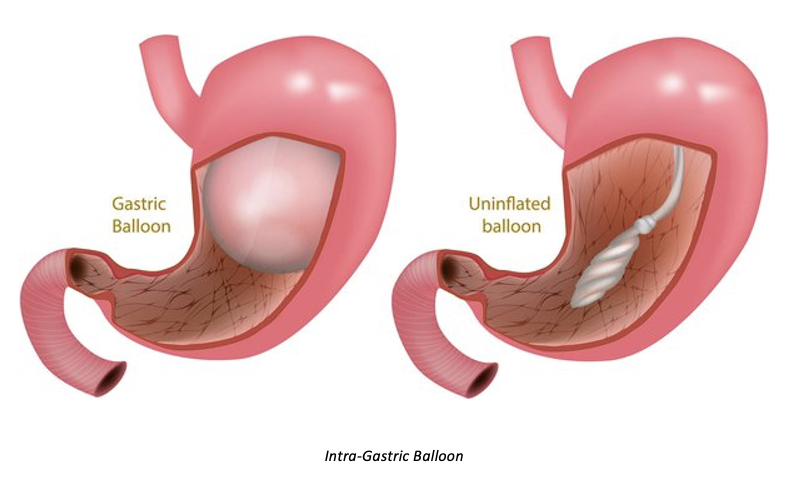 <p><span>Not NICE</span></p><p style="text-align: left;"><span>6 months only</span></p><p style="text-align: left;"><span>Endoscopically inserted</span></p>