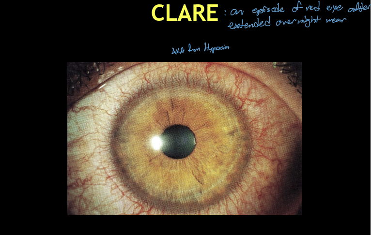 <ul><li><p>Acute inflammatory reaction of the cornea and conjunctiva</p></li><li><p>Occurs after overnight (extended‑wear) soft contact lens use</p></li><li><p>Symptoms classically present upon awakening</p></li></ul><p></p>