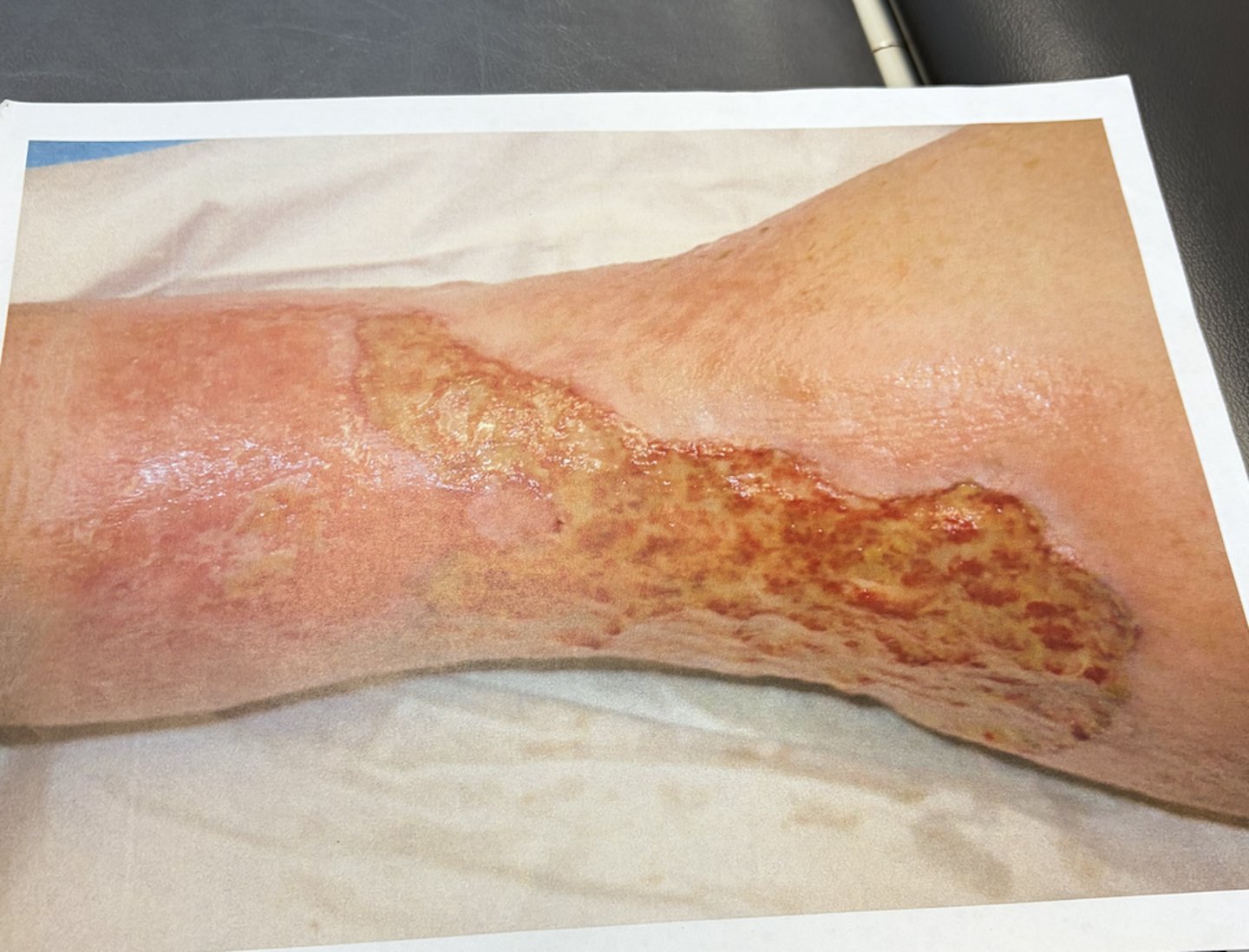 <p>what type of wound is this?</p>