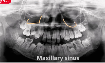 <p><strong>Maxillary sinus</strong></p>