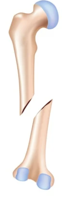 <p>Diagonal fracture with <strong>misaligned fragments</strong> caused by angled force with displacement, requires <strong>reduction</strong> to restore alignment.</p>
