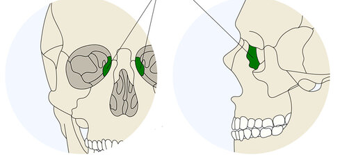 <p>Medial orbit; tear duct</p>