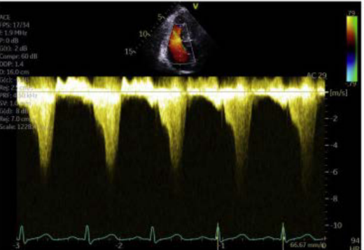 <p>explain what you see the shape dont forget the cardiac cycle when does it peak and wht kind of raising is this</p>