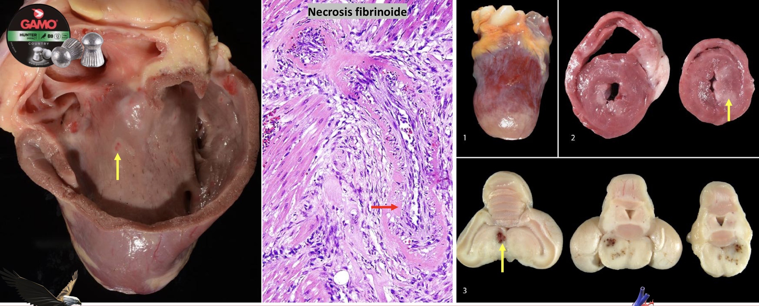 <p>CARDIOVASCULAR: Intoxicacion por plomo </p><p>Miocarditis y encefalitis </p>